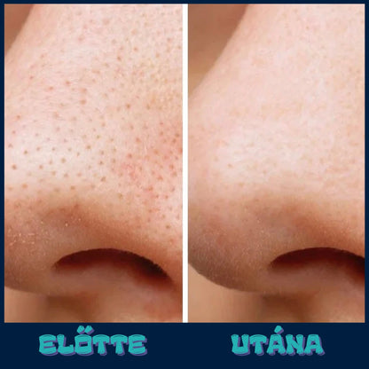 VIF™ DermaPure-vákuumos pórustisztító