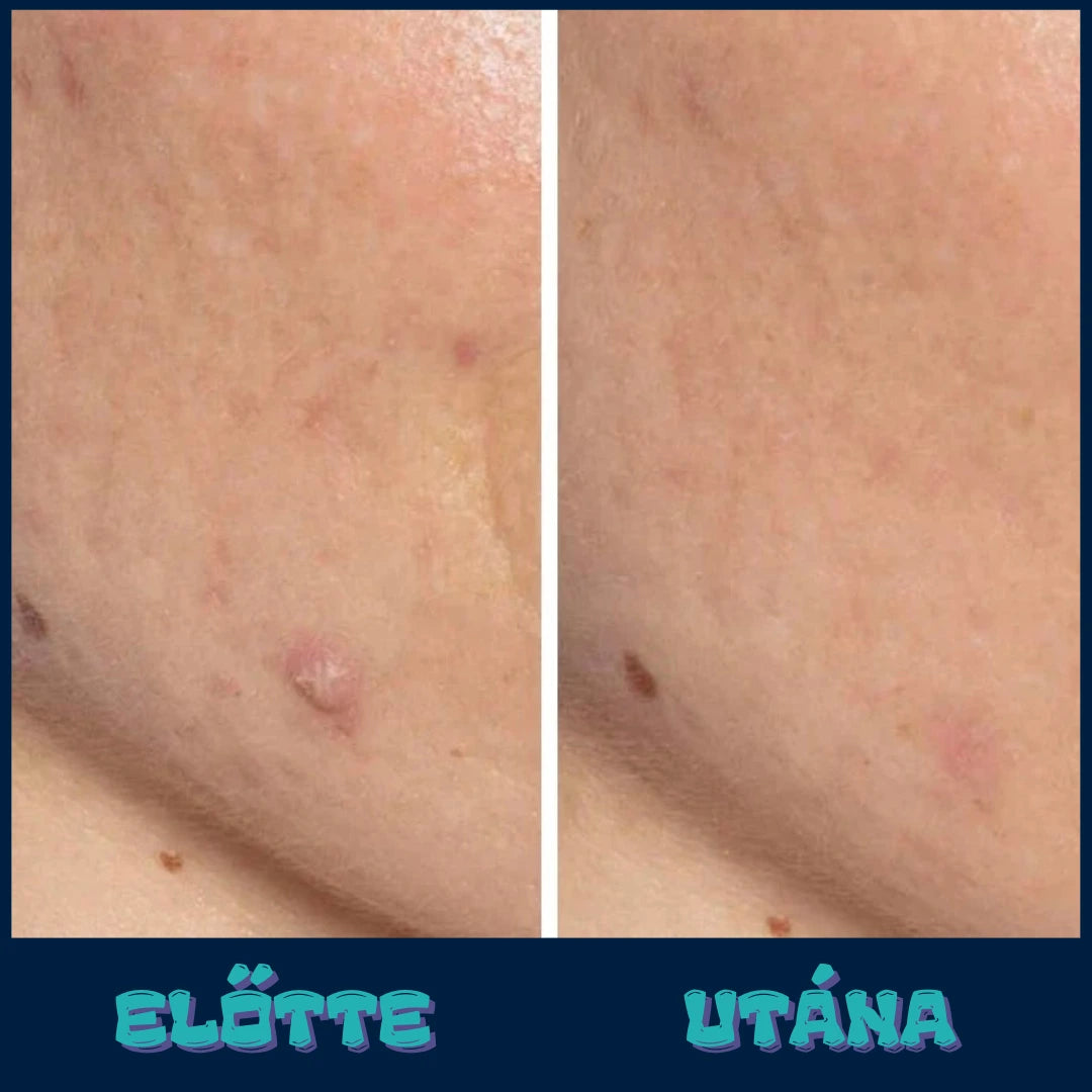 VIF™ DermaPure-vákuumos pórustisztító