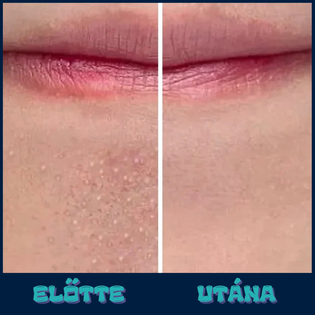 VIF™ DermaPure-vákuumos pórustisztító
