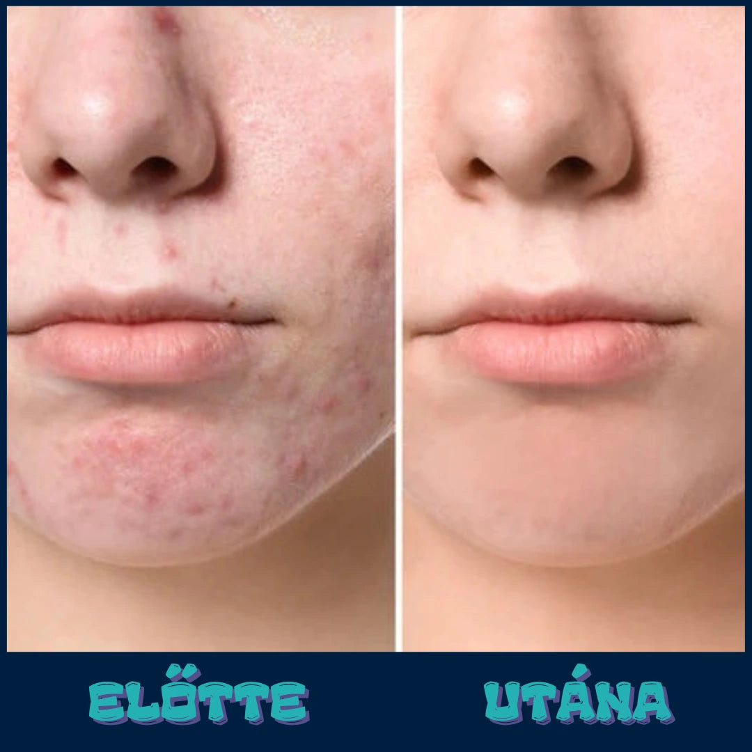 VIF™ DermaPure-vákuumos pórustisztító