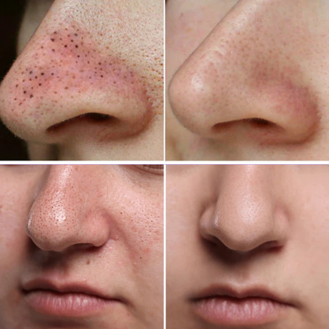 VIF DermaPure vákuumos pórustisztító – otthoni arctisztításhoz