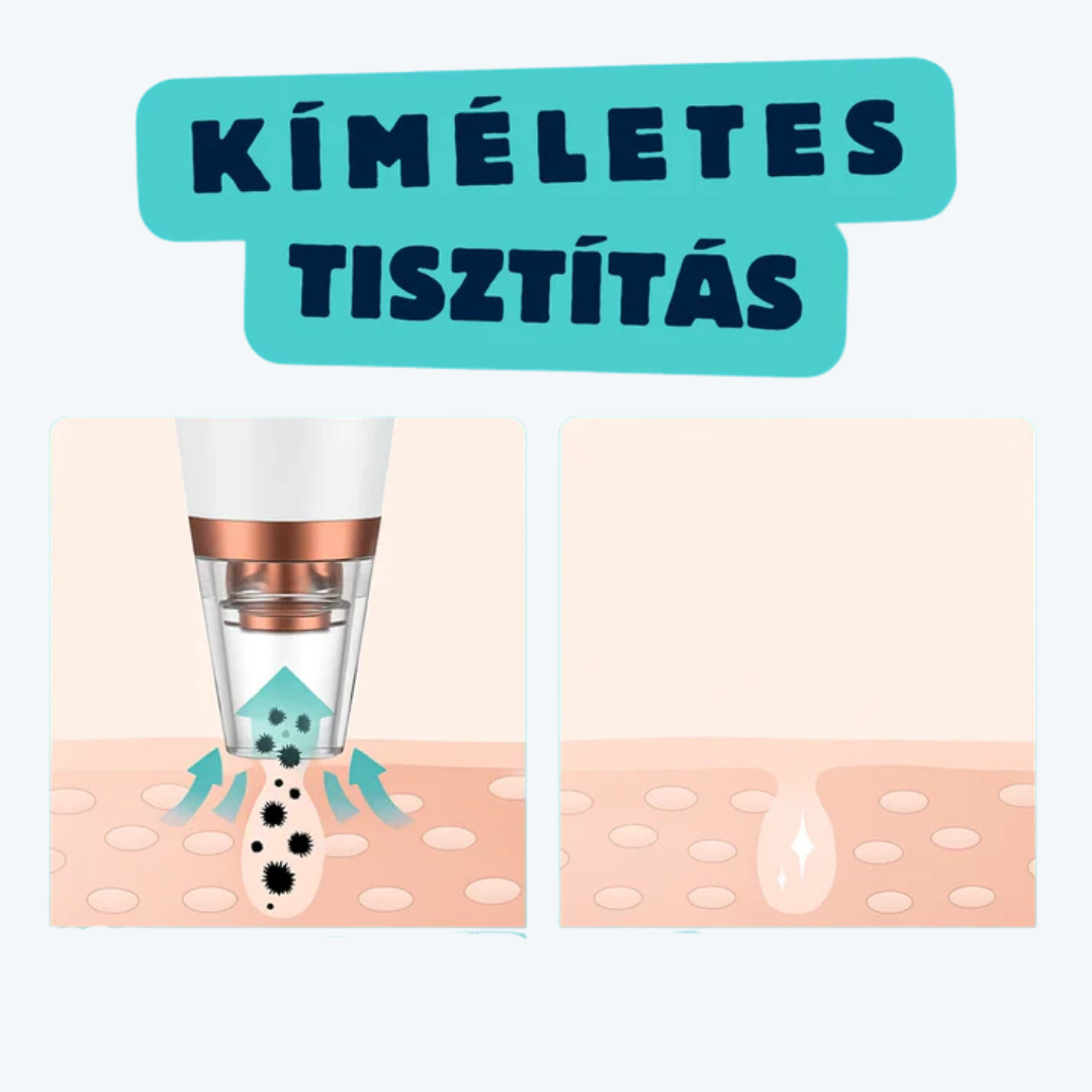 VIF DermaPure vákuumos pórustisztító – otthoni arctisztításhoz
